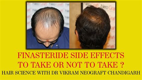 Finasteride: Uses, Dosage, Side Effects, Warnings .